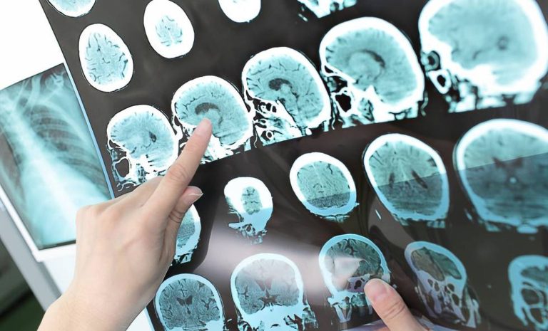 Exame Revolucionário Pode Detectar Alzheimer Até 9 Anos Antes dos Sintomas: Como Suplementos Naturais Podem Ajudar na Prevenção